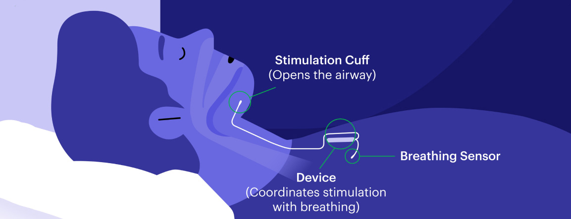 Inspire Sleep Aponea Innovation - Obstructive Sleep Aponea Treatment